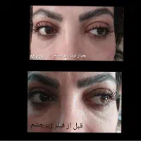 انصاف در تزریق