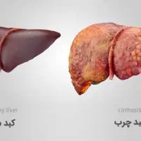 پاکسازی کامل کبدچرب با روش طبیعی