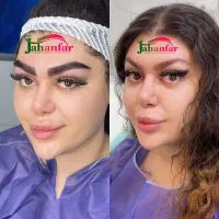 کاشت ابرو حرفه ای و تخصصی،کاشت مو در بهترین کلینیک