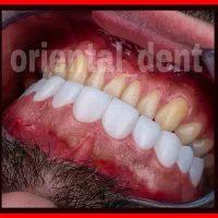 بریج و کامپوزیت و لیفت لثه جرمگیری دندان عصبکشی|خدمات آرایشگری و زیبایی|تهران, تهرانپارس غربی|دیوار