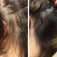 درمان ریزش مو