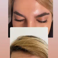 تزریق بوتاکس کل صورت و زیر بغل|خدمات آرایشگری و زیبایی|کرمانشاه, |دیوار