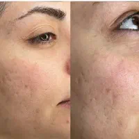 فیشیال حرفه ای