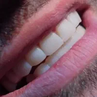 کامپوزیت دندان|خدمات آرایشگری و زیبایی|زنجان, |دیوار