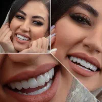 کامپوزیت دندان فقط فکی 5 میلیون