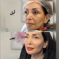 اندولیفت انواع هایفو جوانسازی لیفت ۸۵۰ ت