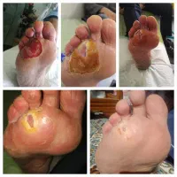 کارشناس تخصصی زخم در منزل. تزریقات و سرم تراپی