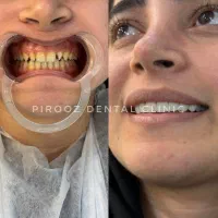 دندانپزشکی اقساطی ایمپلنت کامپوزیت|خدمات زیبایی و سلامت|تهران, چهارصد دستگاه|دیوار