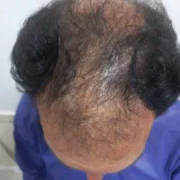 کاشت مو و کاشت اَبرو|خدمات آرایشگری و زیبایی|فسا, |دیوار