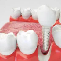 دندانپزشکی/ متخصص جراح فک ولثه /ایمپلنت 9میلیون|خدمات آرایشگری و زیبایی|مشهد, احمدآباد|دیوار