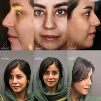 مشاوره تخصصی و رایگان عمل بینی|خدمات زیبایی و سلامت|شیراز, ستارخان|دیوار