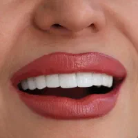 دندانپزشکی کامپوزیت زیبایی اقساط