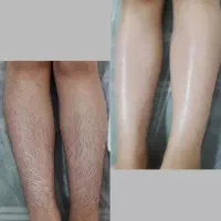 اپیلاسیون تخصصی بانوان