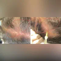 مزوتراپی &  PRP|خدمات آرایشگری و زیبایی|بندر انزلی, شاکوچه|دیوار