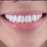 لمینت متحرک دندان