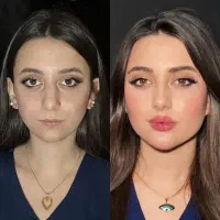 بلفاروپلاستی10/تزریق چربی‌به‌بدن هر100سی‌سی10میلیو