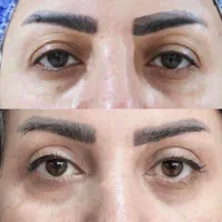 بلفاروپلاستی بلفارو ساکشن غبغب پزشک جراح پلاستیک