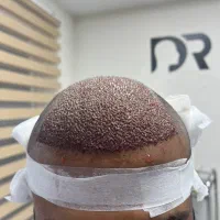 کاشت مو ابرومژه داعمی|خدمات آرایشگری و زیبایی|کرج, کوی امامیه|دیوار