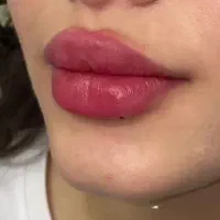 تزریق ژل و بوتاکس فیلر جوانسازی