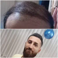 جشنواره کاشت مو
