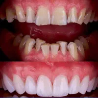 کامپوزیت دندان روکش دندانپزشک تهرانسر اکباتان خلیج|خدمات آرایشگری و زیبایی|تهران, تهرانسر شمالی|دیوار