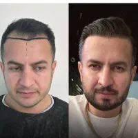 جشنواره پاییزه کاشت مو و کاشت ابرو