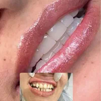 تخفیف کامپوزیت ونیر دندان