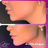 جشنوار تابستانه ژل و بوتاکس و شرایط اقساطی|خدمات آرایشگری و زیبایی|آمل, |دیوار
