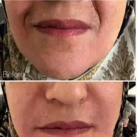 بوتاکس وتزریق ژل لیفت نخ بلفاروساکشن وکاشت مو|خدمات آرایشگری و زیبایی|مشهد, آزادشهر|دیوار