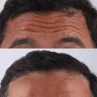 ژل فیلر بوتاکس مزو هایفو لب|خدمات آرایشگری و زیبایی|اسلامشهر, شهرک قائمیه|دیوار