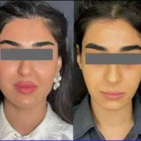 ژل لب بوتاکس فیلر مزو ژل یانگ فیس پی ارپی نخ لیفت|خدمات آرایشگری و زیبایی|مشهد, احمدآباد|دیوار