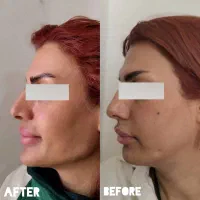 تزریق فیلر و بوتاکس در بندرعباس