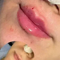 تخفیفات بزرگژل وبوتاکس در مشهد|خدمات آرایشگری و زیبایی|مشهد, کوثر|دیوار