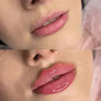 جشنواره تزریق ژل و بوتاکس 450|خدمات زیبایی و سلامت|تهران, نازی‌آباد|دیوار
