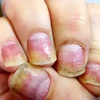 درمان پسوریازیس وصدف