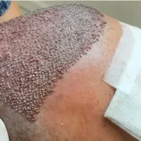 مدل کاشت مو