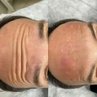 بوتاکس مصپورت.تزریقات وپانسمان و سوراخ کردن گوش|خدمات آرایشگری و زیبایی|اراک, |دیوار