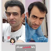 کاشت مو تضمینی در یک جلسه با تکنیک شیرازی|خدمات آرایشگری و زیبایی|یزد, |دیوار
