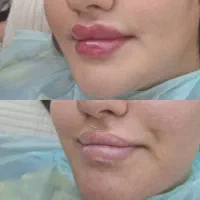 تزریق ژل|خدمات آرایشگری و زیبایی|زنجان, |دیوار