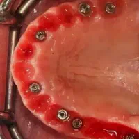 تخصصی ترین مرکز ایمپلنت و دندانپزشکی در تبریز