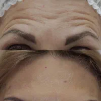 فیلر زیر چشم،ژل ،بوتاکس ،خدمات جوانسازی صورت|خدمات آرایشگری و زیبایی|اندیشه, اندیشه فاز ۱|دیوار