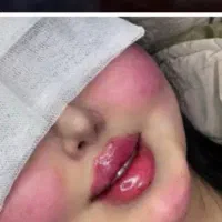 ساکشن چربی ژل بوتاکس تزریقات