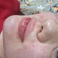 تزریق تخصصی فیلر و بوتاکس و مزو و..