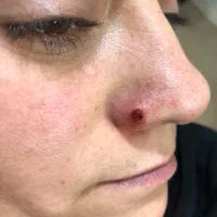 حذف انواع خال (گوشتی،سطحی،زیگیل)|خدمات آرایشگری و زیبایی|کاشان, فاز ۲ ناجی آباد|دیوار