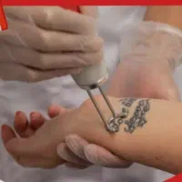 پاک کردن تاتو