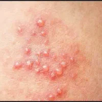 رفع ریشه ای زگیل و تبخال تناسلی