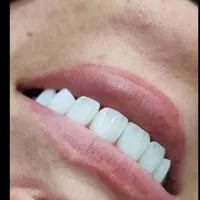 کامپوزیت لمینت روکش|پزشکی|ری, شهرری|دیوار