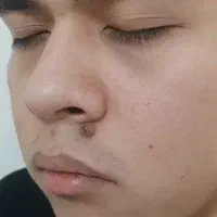 برداشتن.خال گوشتی.خال.نشونه.خال مادرزادی