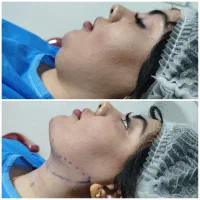 جراحی بلفارو پلاستی ساکشن غبغب بوکال فت سانترال .|خدمات آرایشگری و زیبایی|کرج, فاز ۳ مهرشهر|دیوار