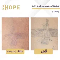 لیزر تتو و لک 2025 آماده تحویل|آرایشی، بهداشتی، درمانی|شیراز, قدوسی غربی|دیوار